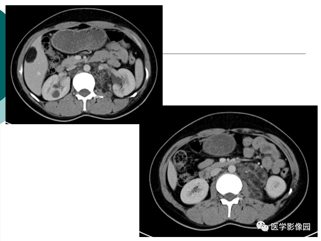 【病例】肺淋巴管肌瘤病1例CT