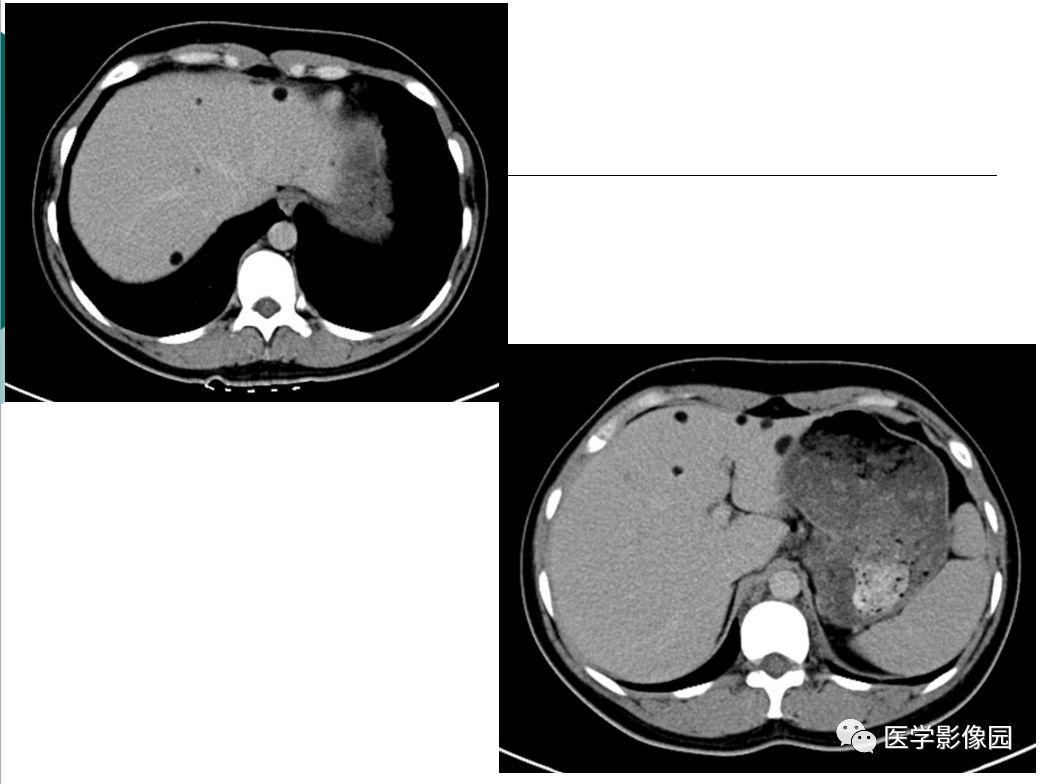 【病例】肺淋巴管肌瘤病1例CT