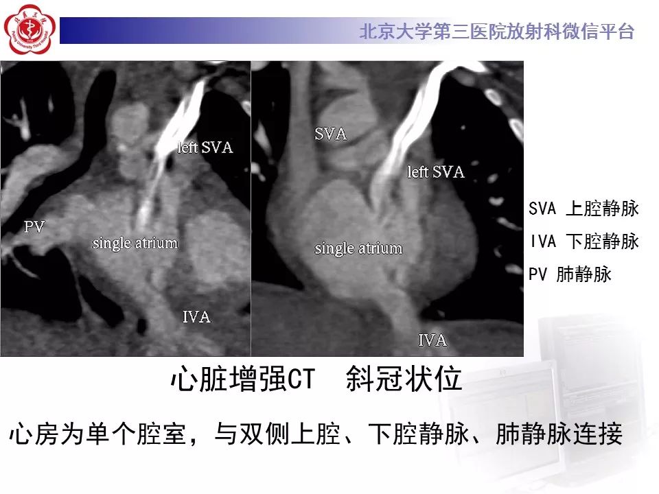 【病例】先天性心脏病——房室间隔缺损