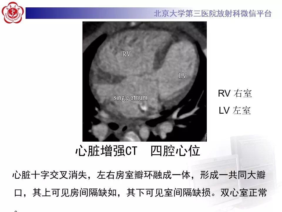 【病例】先天性心脏病——房室间隔缺损