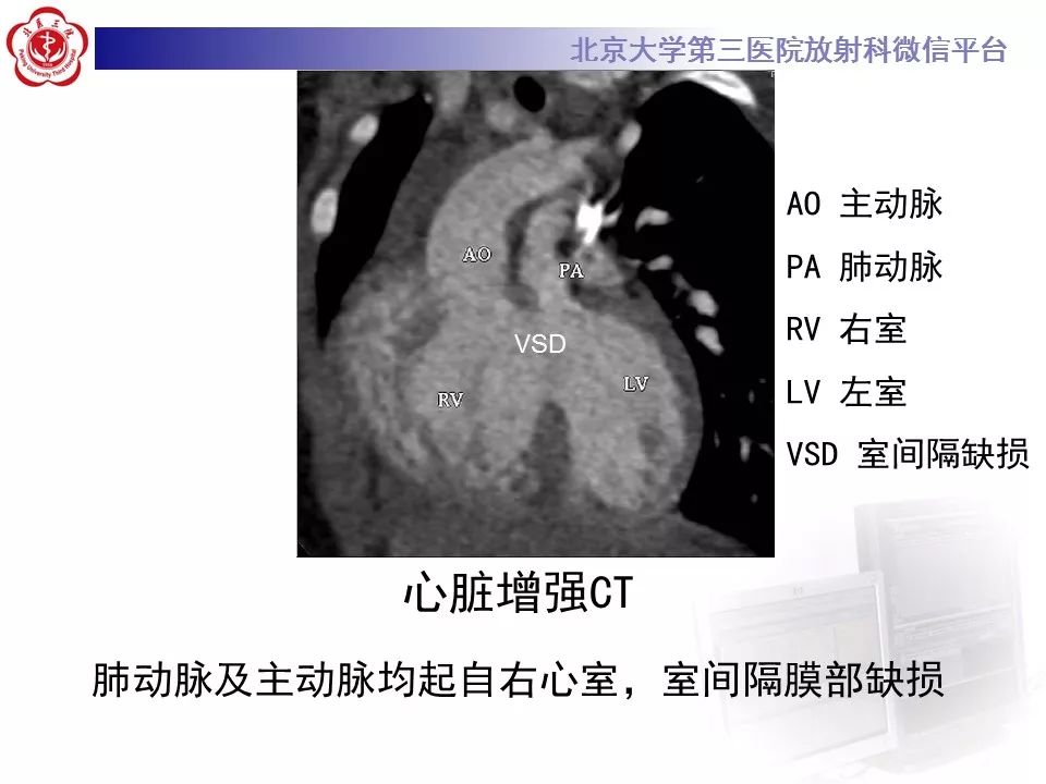 【病例】先天性心脏病——房室间隔缺损