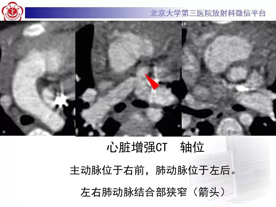 【病例】先天性心脏病——房室间隔缺损
