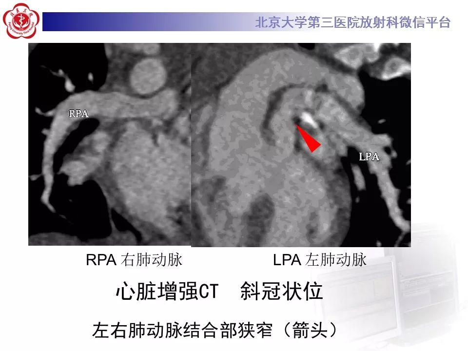 【病例】先天性心脏病——房室间隔缺损