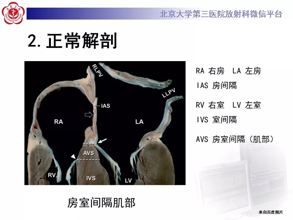 【病例】先天性心脏病——房室间隔缺损