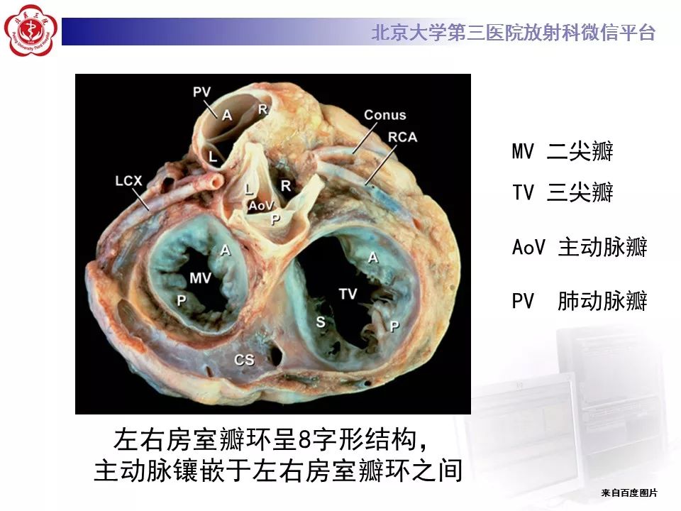 【病例】先天性心脏病——房室间隔缺损