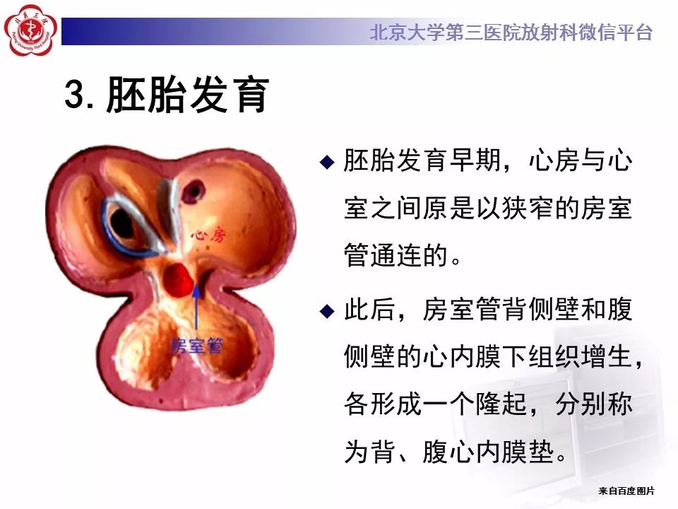 【病例】先天性心脏病——房室间隔缺损