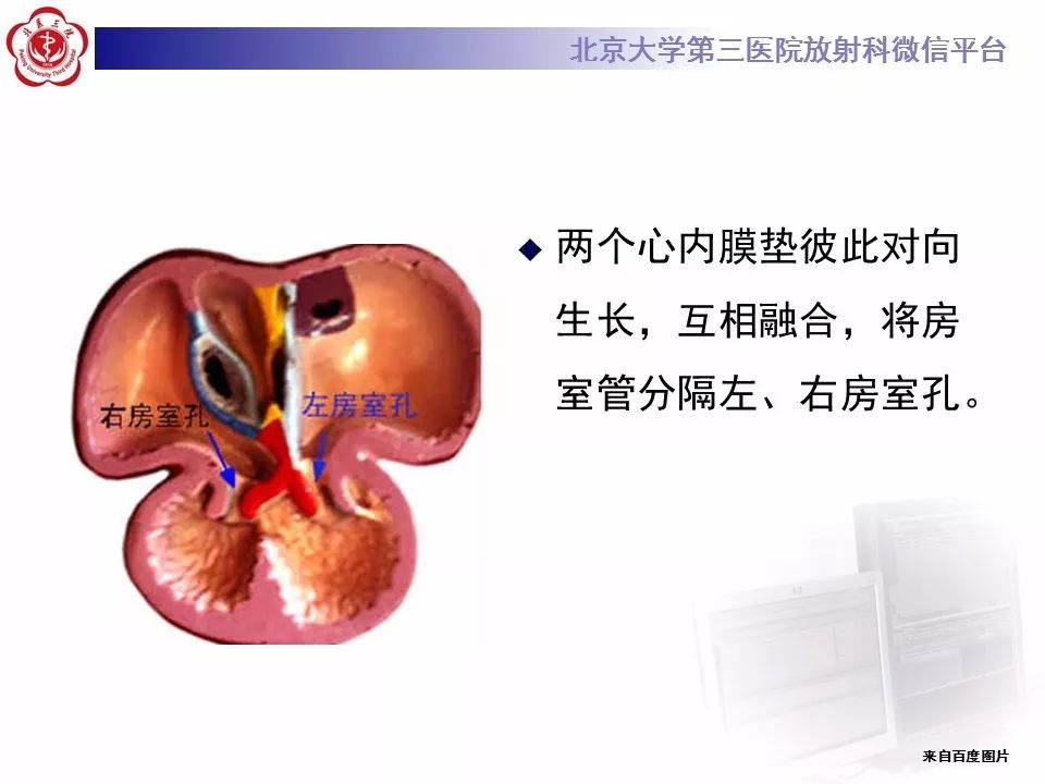 【病例】先天性心脏病——房室间隔缺损