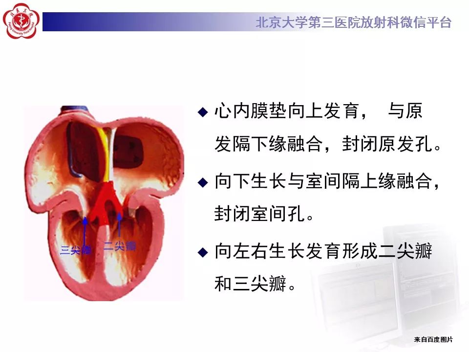 【病例】先天性心脏病——房室间隔缺损