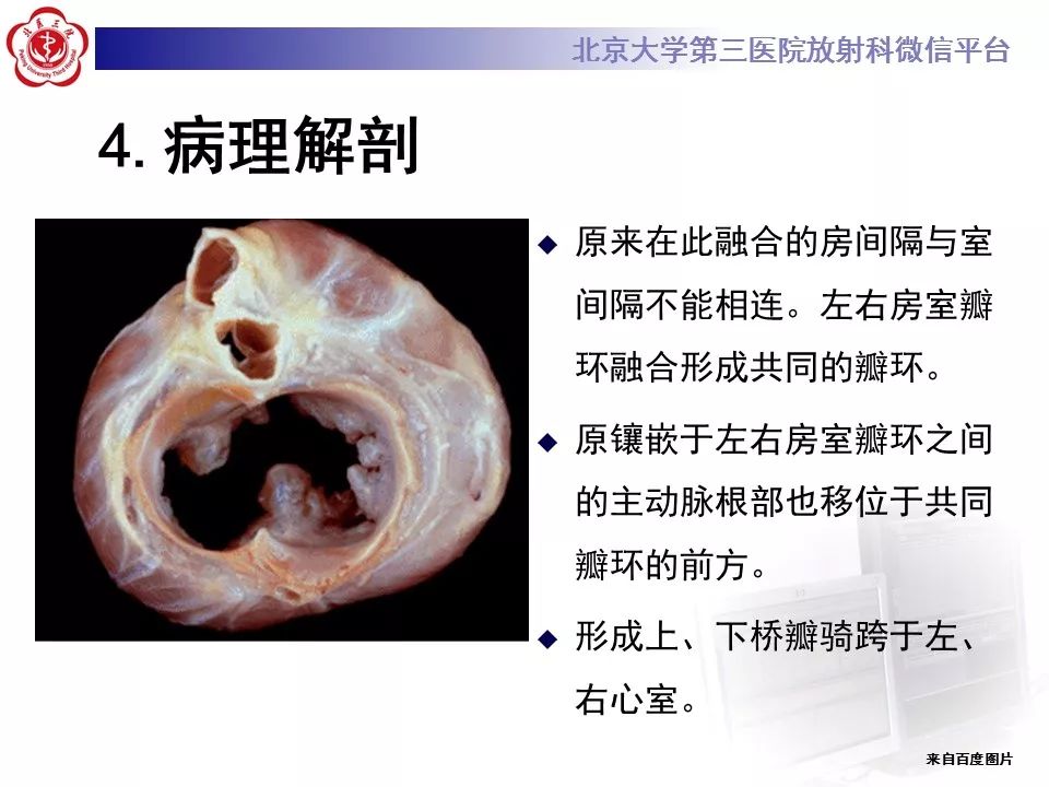 【病例】先天性心脏病——房室间隔缺损