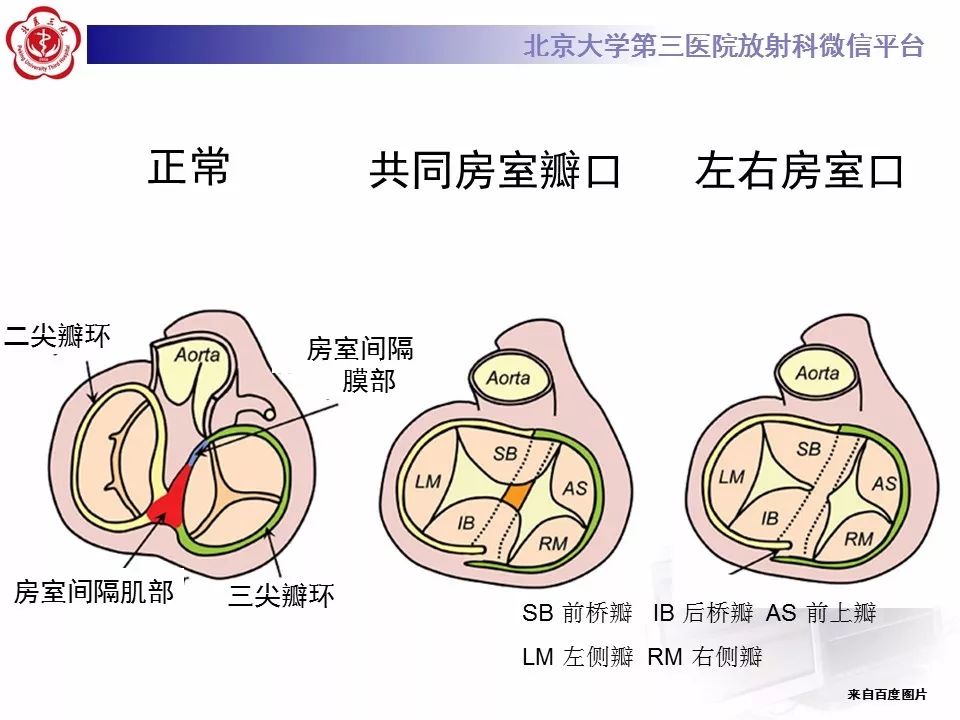 【病例】先天性心脏病——房室间隔缺损