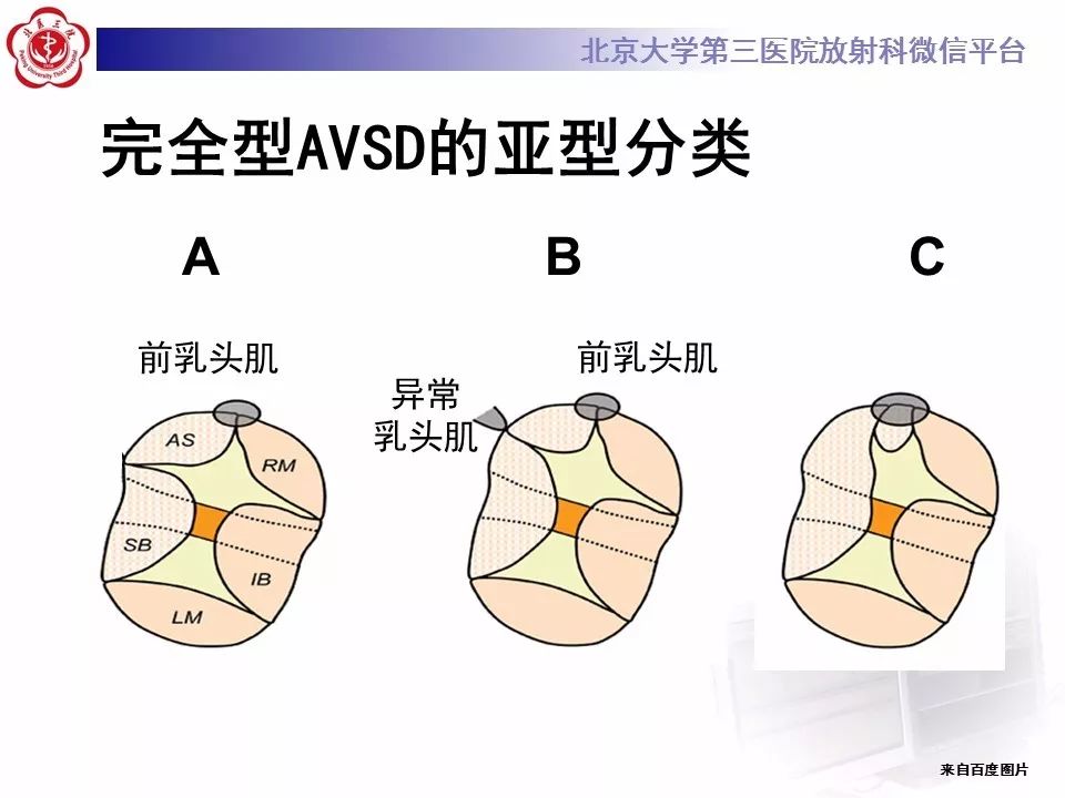 【病例】先天性心脏病——房室间隔缺损