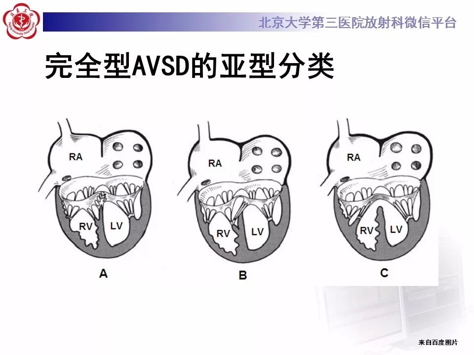 【病例】先天性心脏病——房室间隔缺损