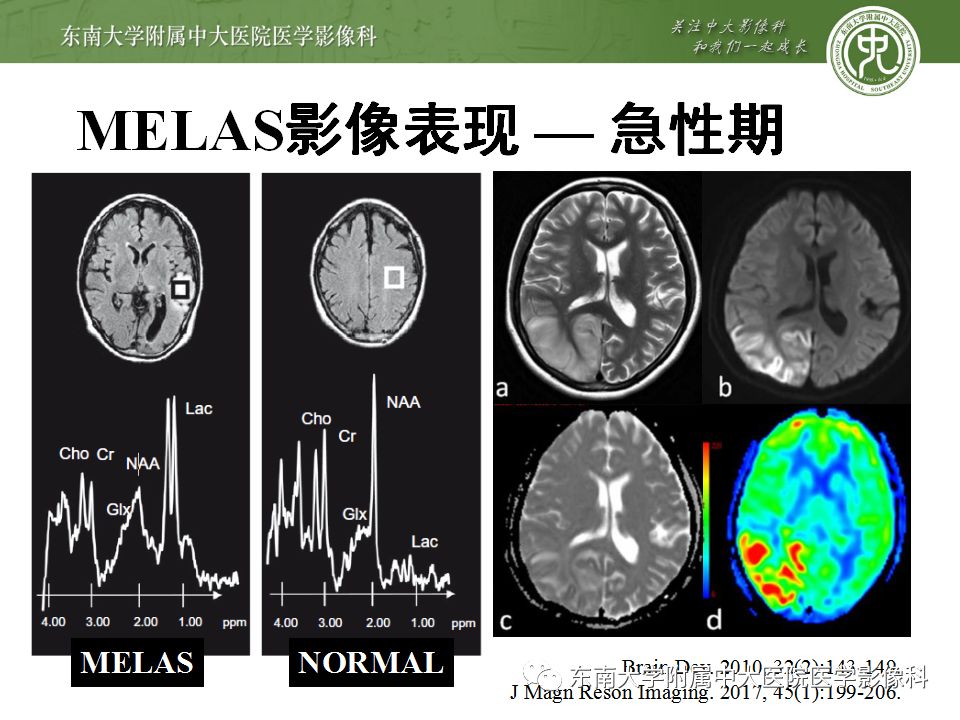 【病例】线粒体脑肌病1例MR影像表现