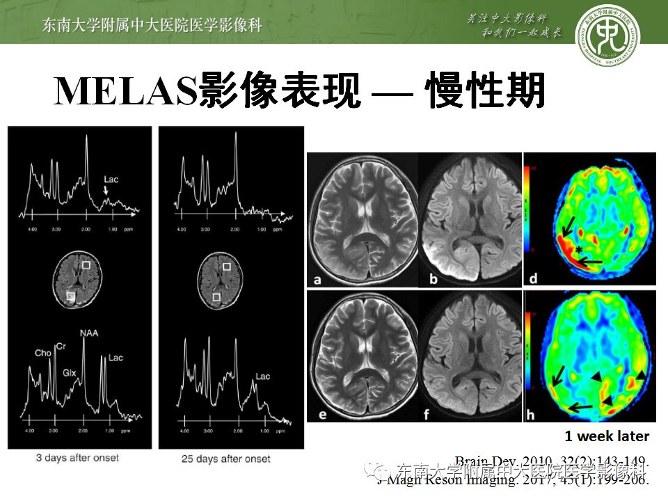 【病例】线粒体脑肌病1例MR影像表现