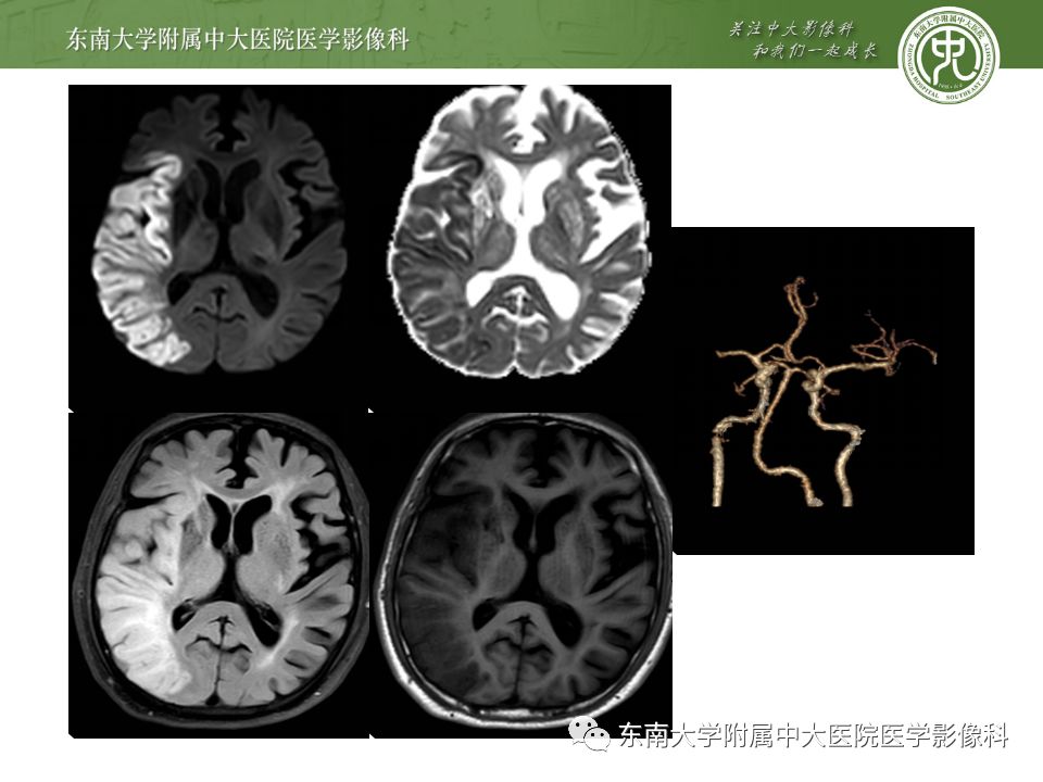 【病例】线粒体脑肌病1例MR影像表现