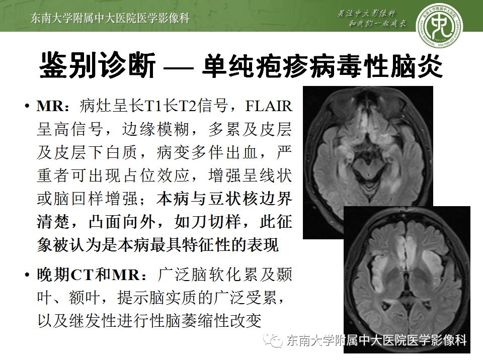 【病例】线粒体脑肌病1例MR影像表现