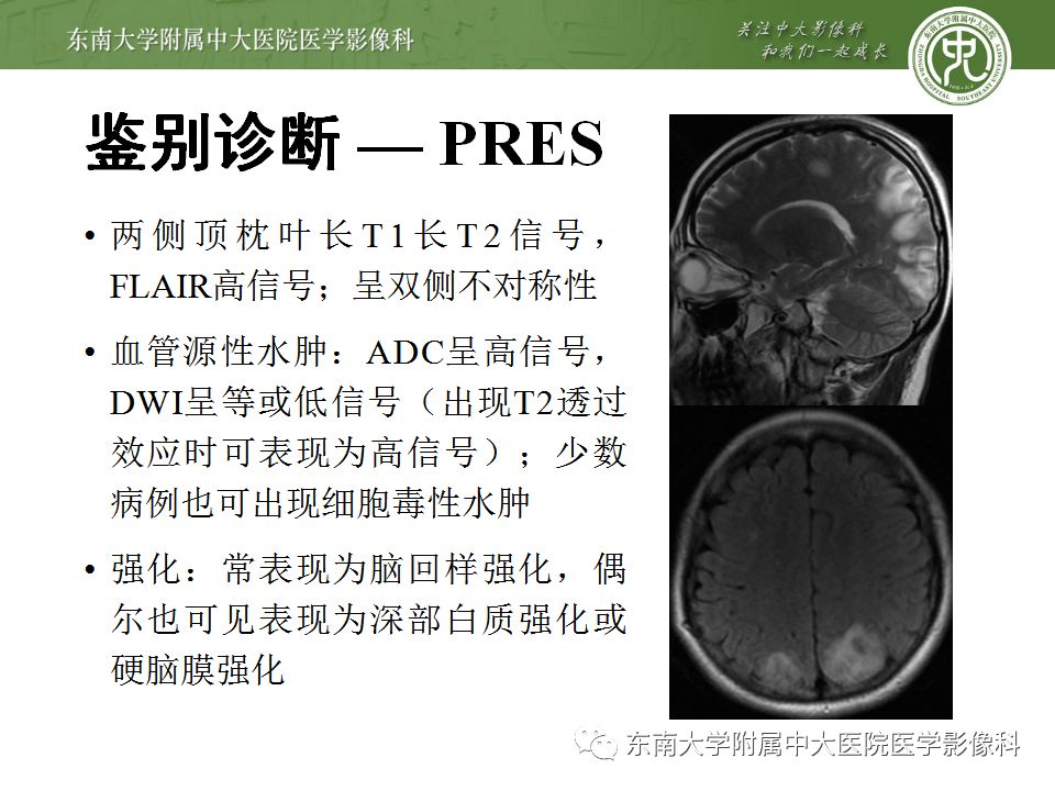 【病例】线粒体脑肌病1例MR影像表现