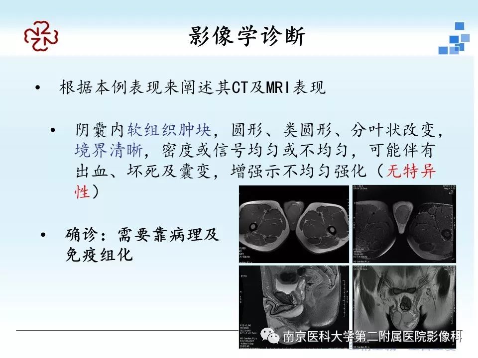 【病例】附睾恶性间皮瘤1例MR