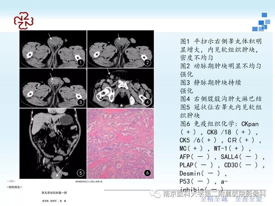 【病例】附睾恶性间皮瘤1例MR