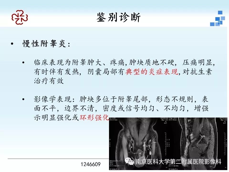 【病例】附睾恶性间皮瘤1例MR