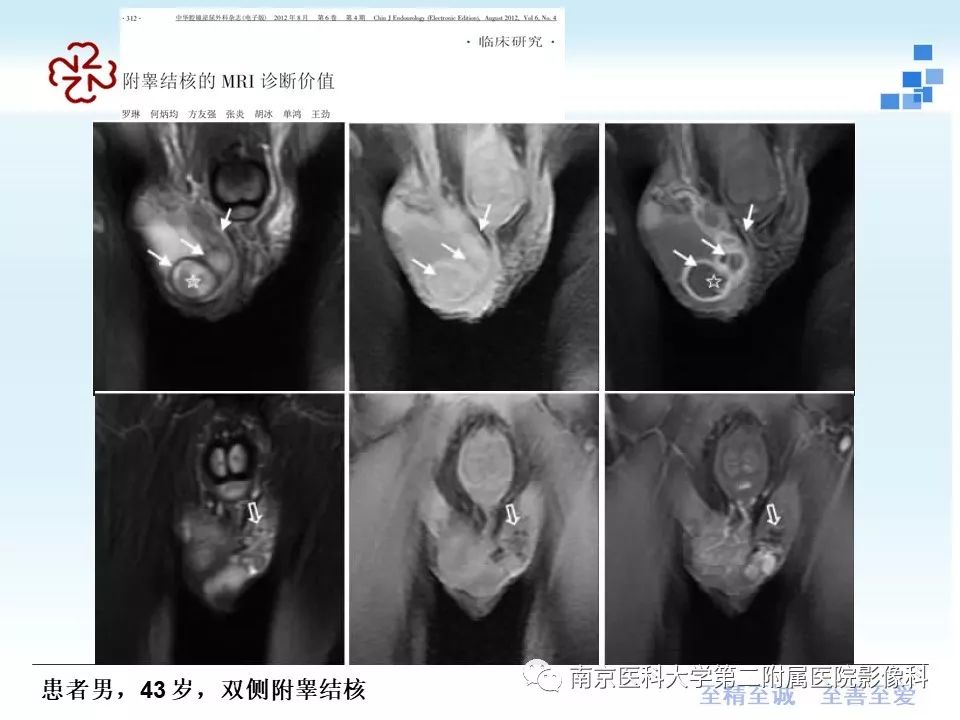 【病例】附睾恶性间皮瘤1例MR