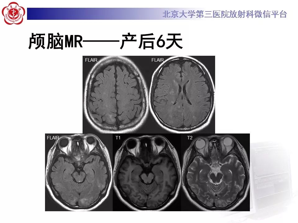 【病例】可逆性后部脑病综合征1例MR