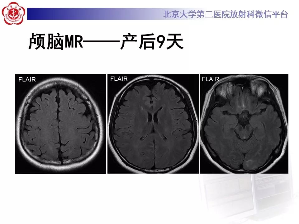 【病例】可逆性后部脑病综合征1例MR