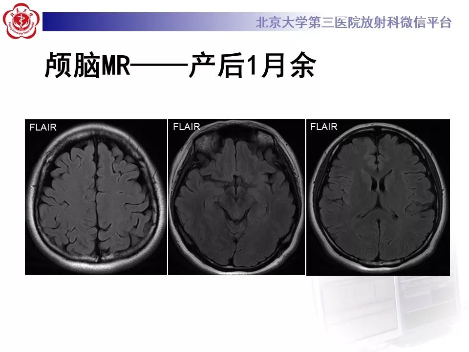 【病例】可逆性后部脑病综合征1例MR