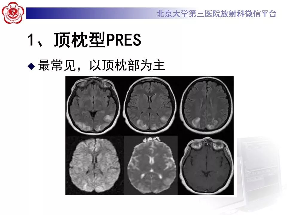 【病例】可逆性后部脑病综合征1例MR
