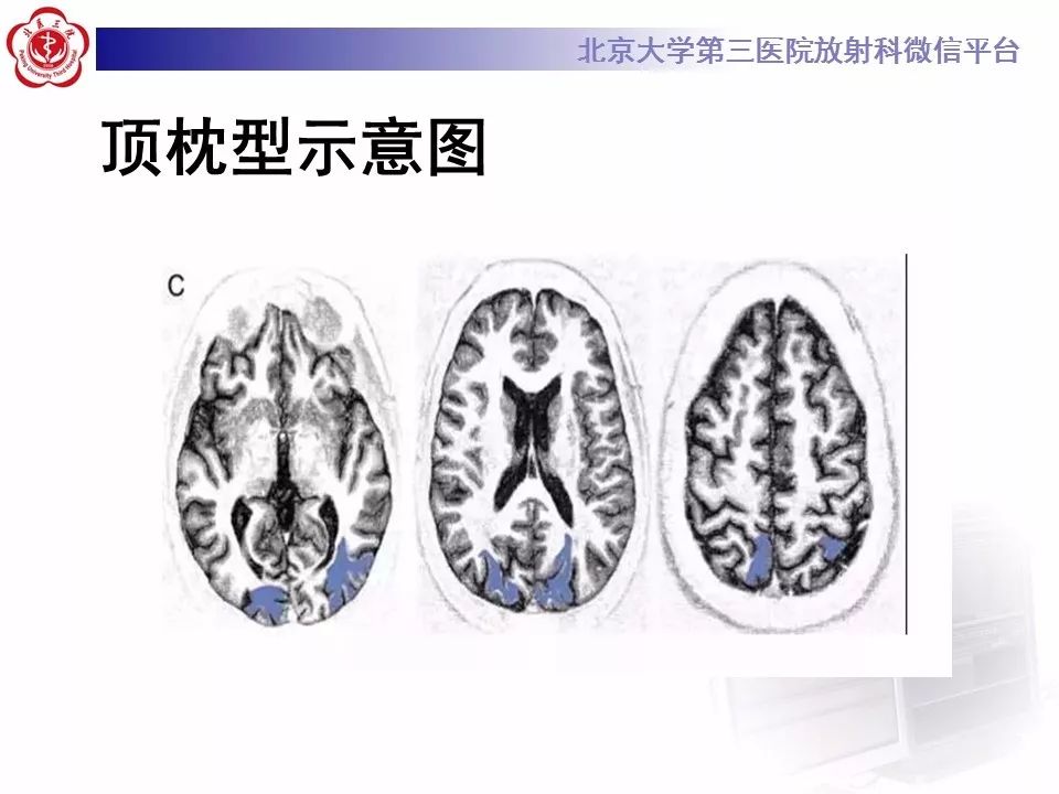 【病例】可逆性后部脑病综合征1例MR