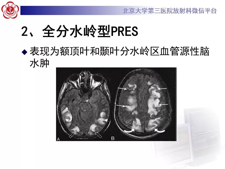 【病例】可逆性后部脑病综合征1例MR