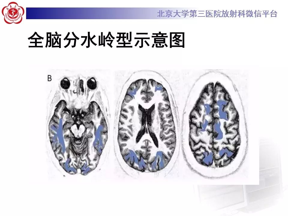 【病例】可逆性后部脑病综合征1例MR