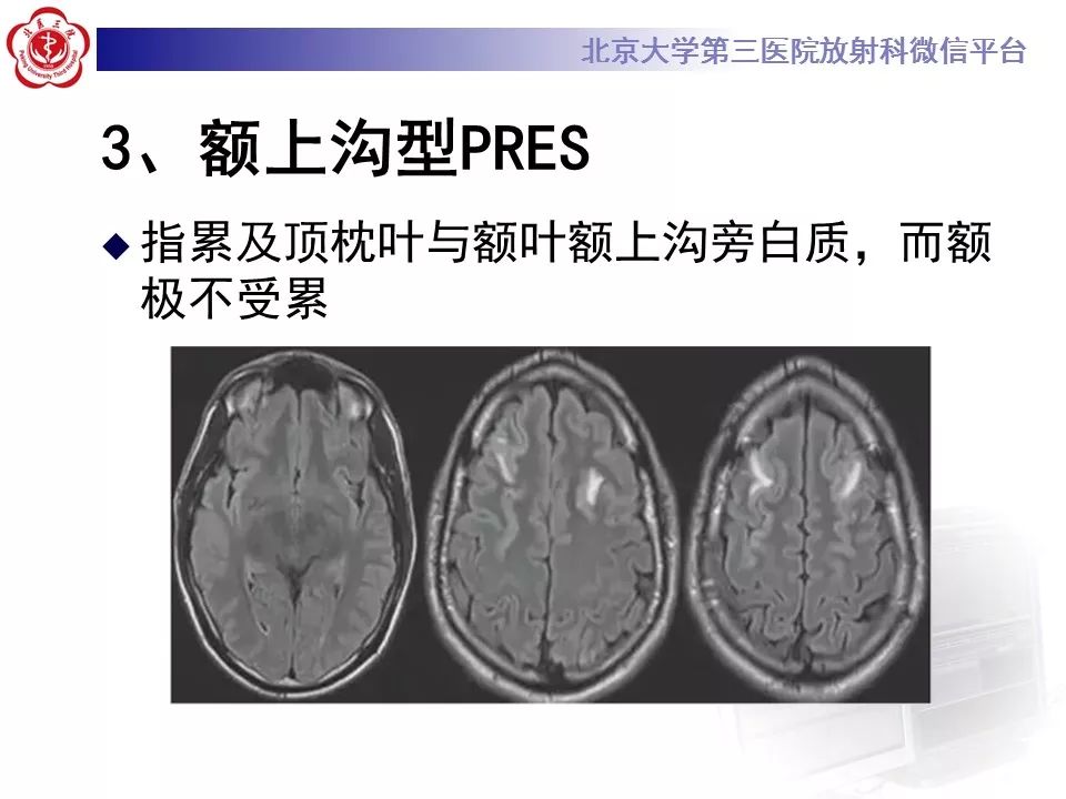 【病例】可逆性后部脑病综合征1例MR