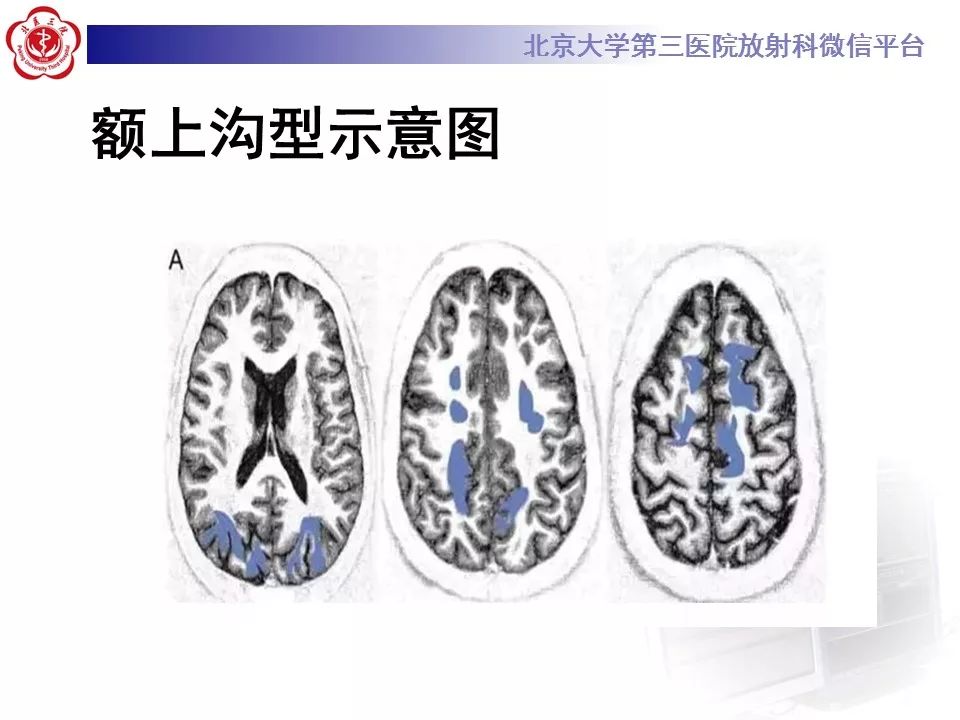 【病例】可逆性后部脑病综合征1例MR