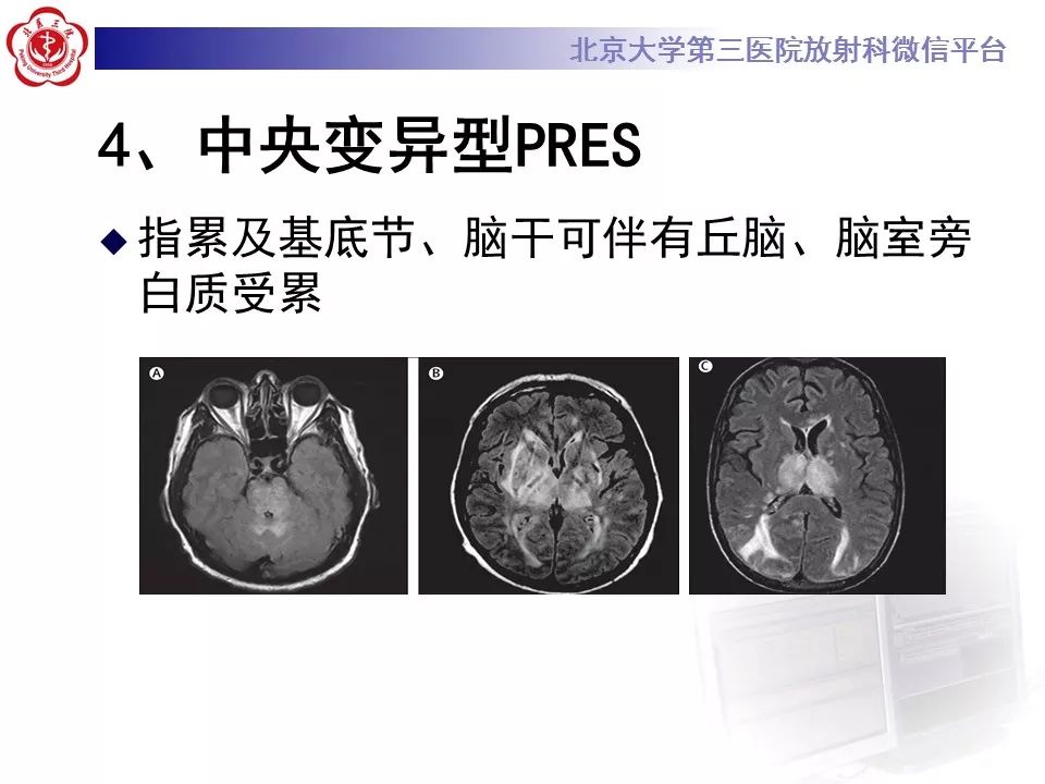 【病例】可逆性后部脑病综合征1例MR