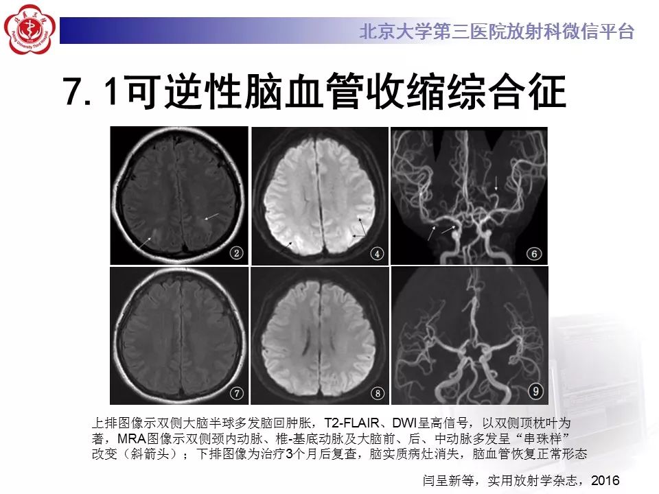 【病例】可逆性后部脑病综合征1例MR
