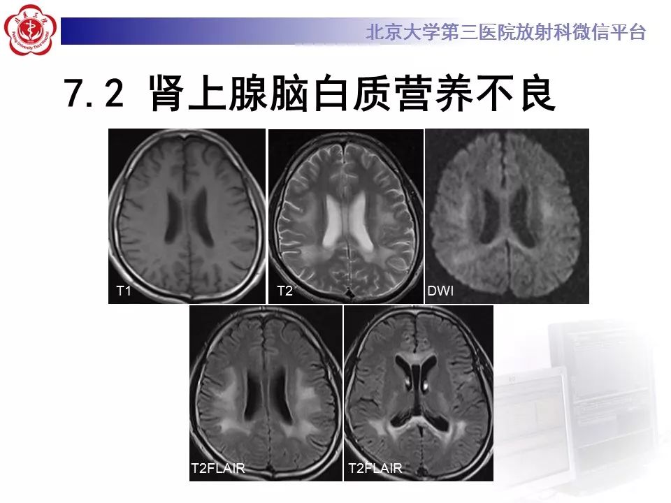 【病例】可逆性后部脑病综合征1例MR