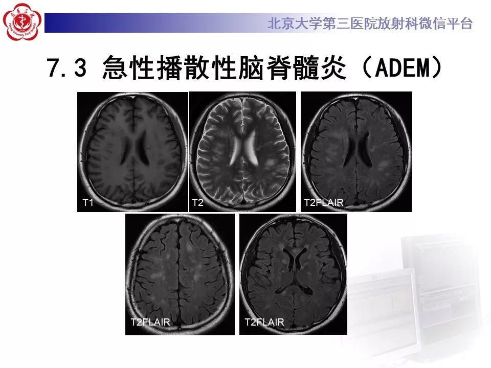 【病例】可逆性后部脑病综合征1例MR