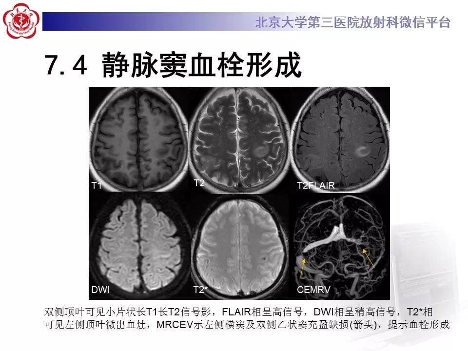 【病例】可逆性后部脑病综合征1例MR