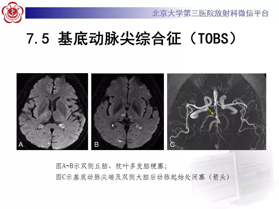 【病例】可逆性后部脑病综合征1例MR
