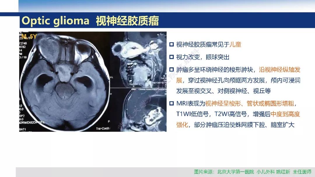 【PPT】颅眶沟通性病变影像诊断
