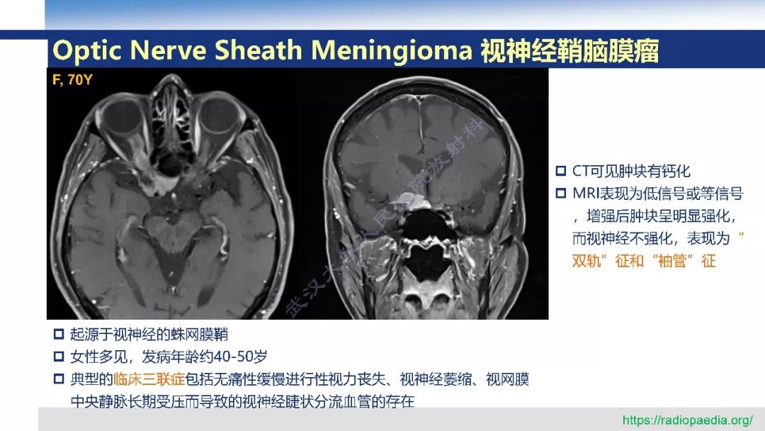【PPT】颅眶沟通性病变影像诊断