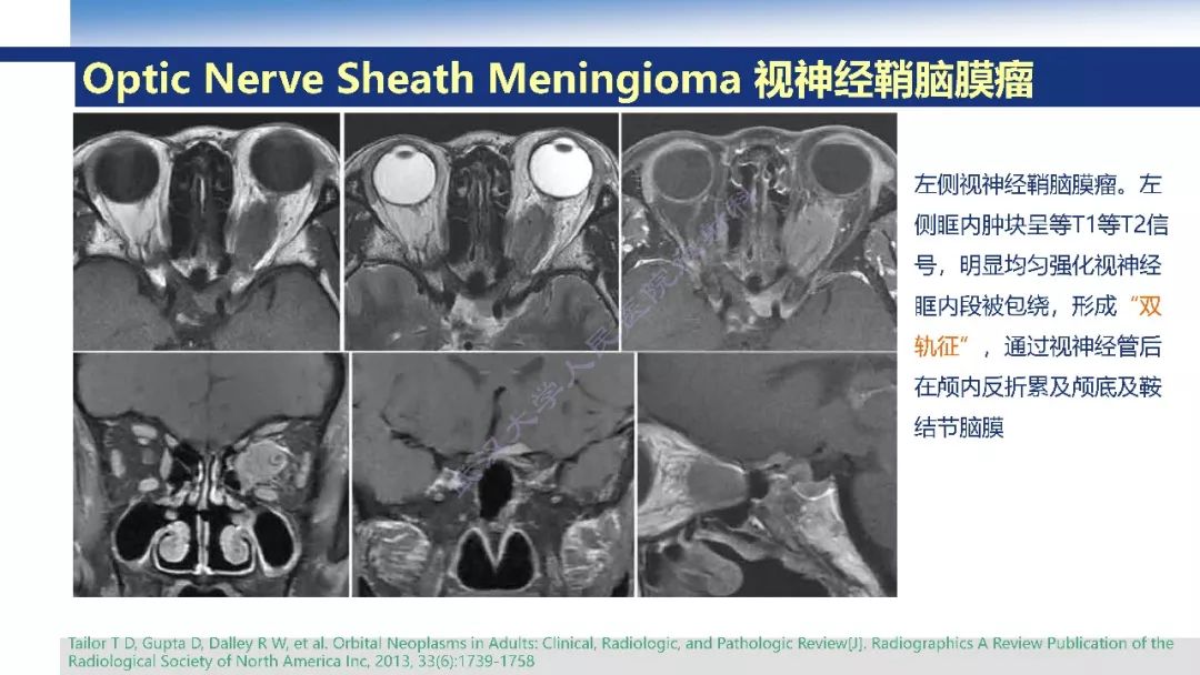【PPT】颅眶沟通性病变影像诊断