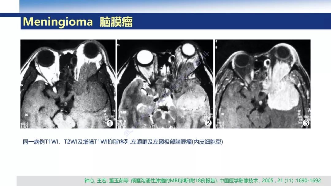 【PPT】颅眶沟通性病变影像诊断