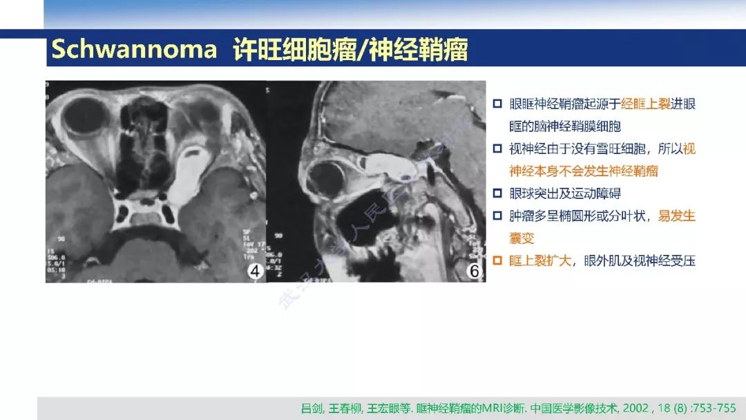 【PPT】颅眶沟通性病变影像诊断