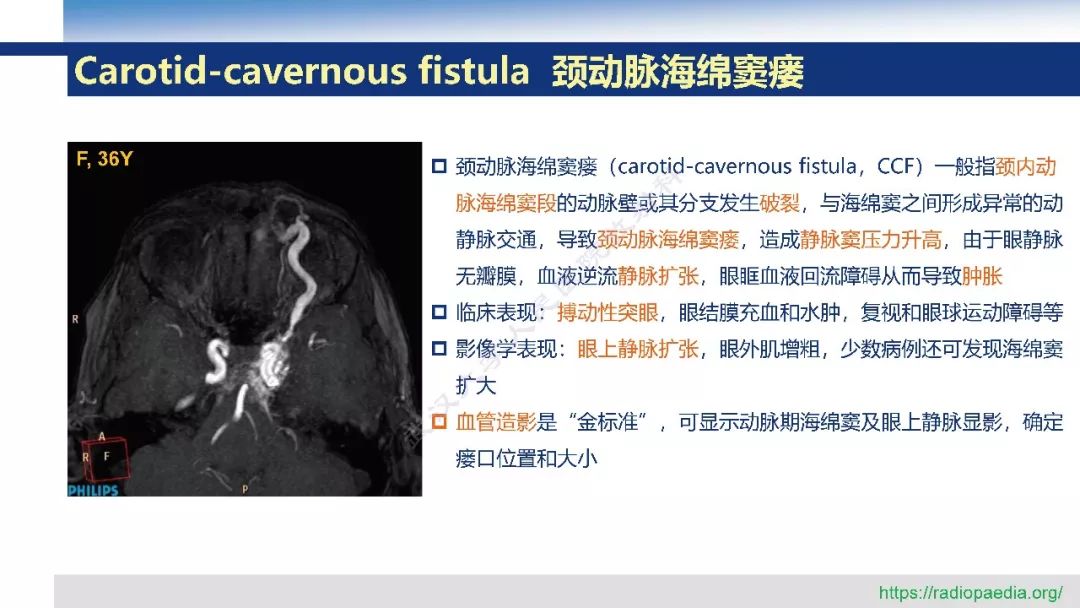 【PPT】颅眶沟通性病变影像诊断