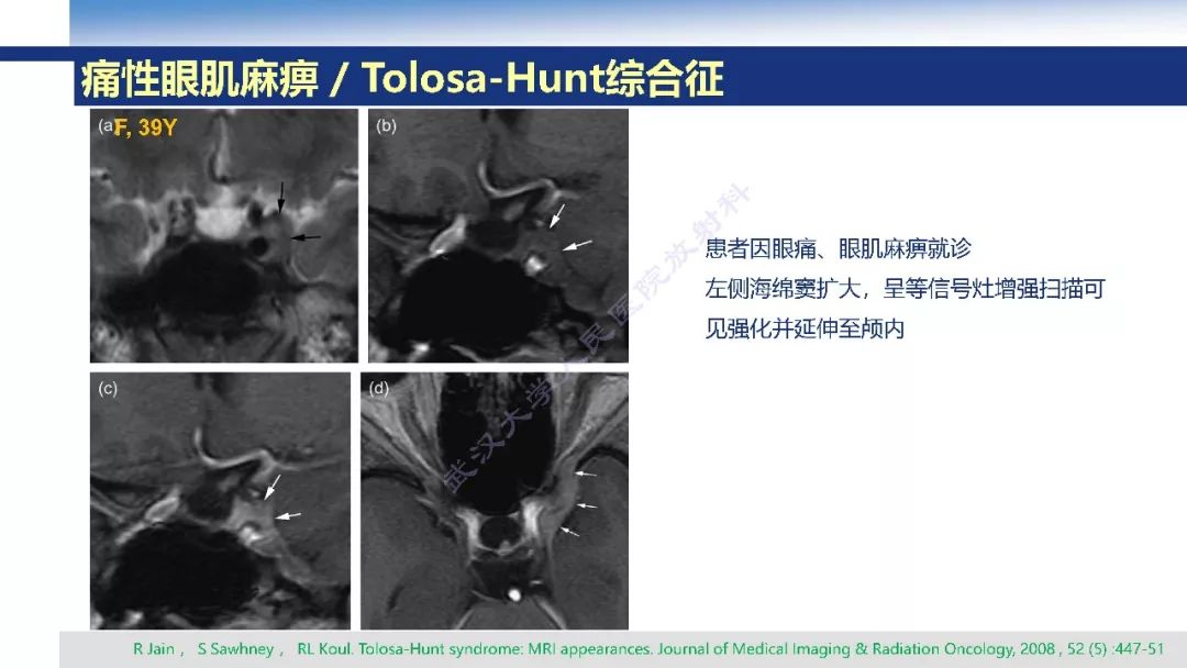 【PPT】颅眶沟通性病变影像诊断