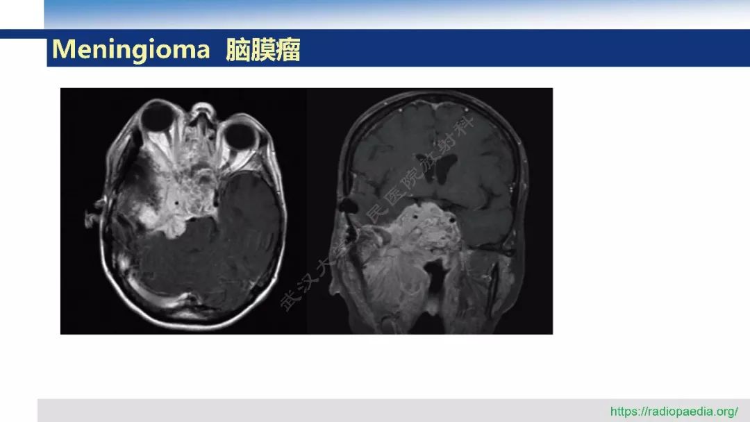 【PPT】颅眶沟通性病变影像诊断