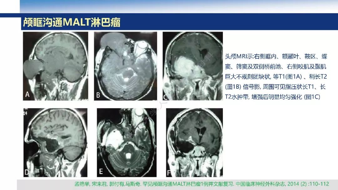 【PPT】颅眶沟通性病变影像诊断