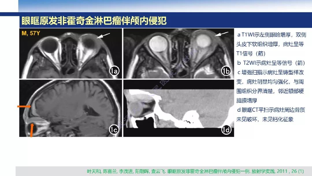【PPT】颅眶沟通性病变影像诊断